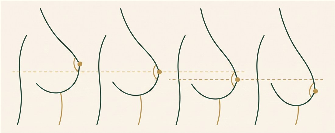 Four breast profiles showing progressive ptosis (pseudoptosis, Grade I, II, III) with the nipple descending relative to the inframammary crease