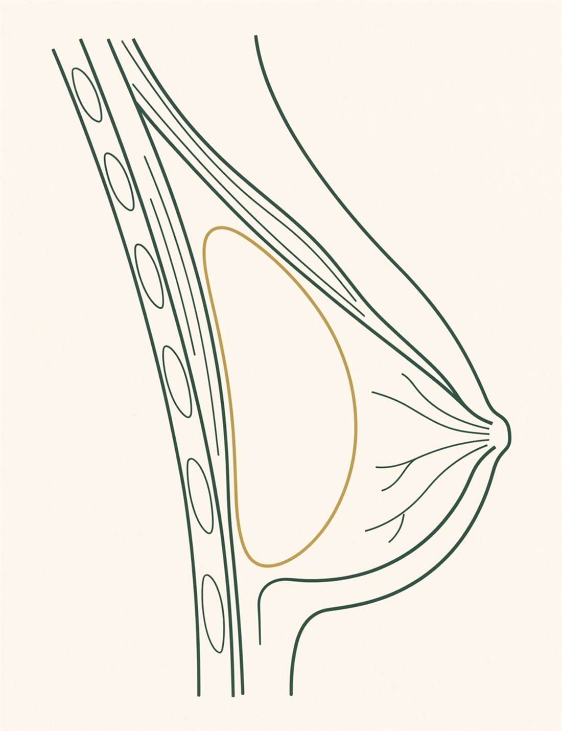 Cross-section of the breast comparing implant placement under the muscle (submuscular / dual plane) versus over the muscle (subglandular)