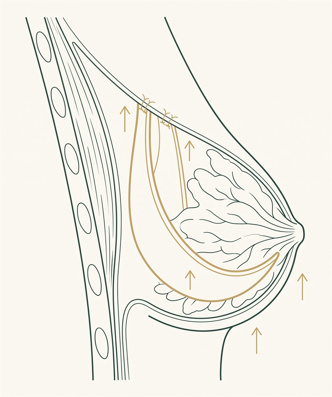 Breast in profile: an internal support band of the patient's own tissue reinforcing the inframammary fold to hold the implant in position