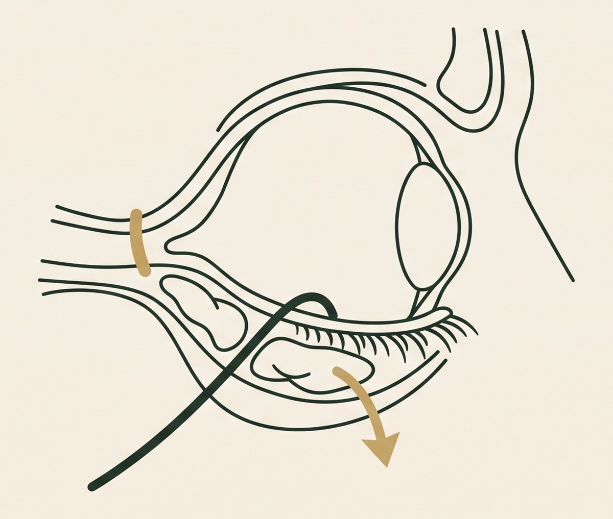 Lower-eyelid cross-section: the herniated fat bag repositioned downward into the tear-trough hollow, the transconjunctival approach from inside the lid, and canthopexy support at the outer corner