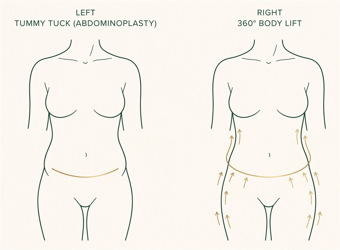 Comparison: a tummy tuck treats the front only, while a 360 body lift removes skin all the way around and lifts the buttocks and thighs