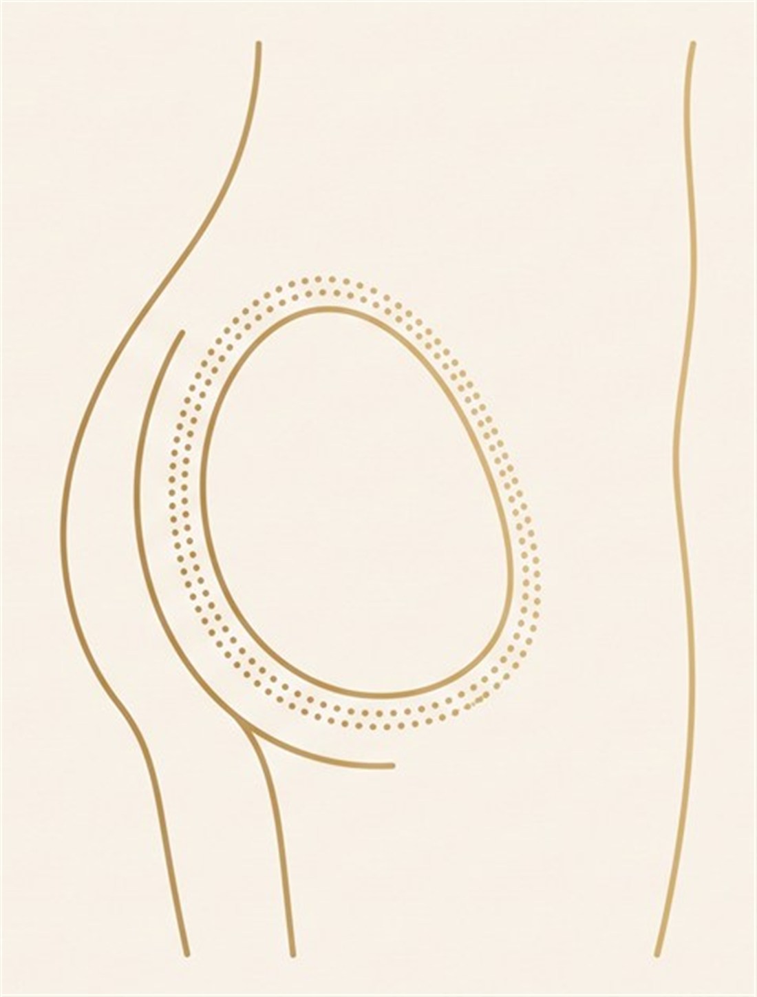 Buttock profile: a silicone implant with a layer of grafted fat over and around it, blending into the natural contour
