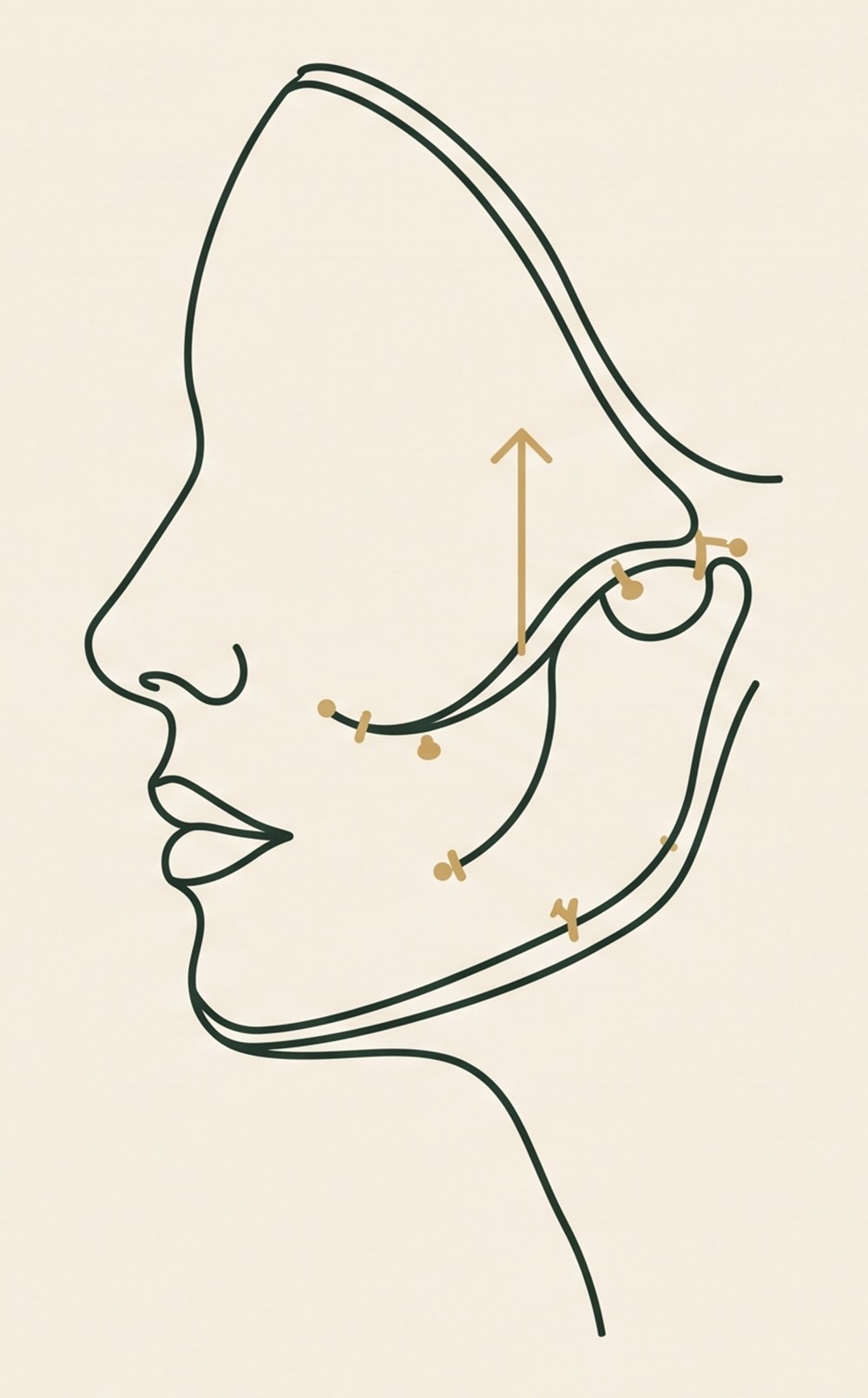 Face profile diagram: the SMAS / deep-plane layer, the retaining ligaments being released, and an upward arrow showing the deep tissue repositioned vertically while the skin is redraped tension-free