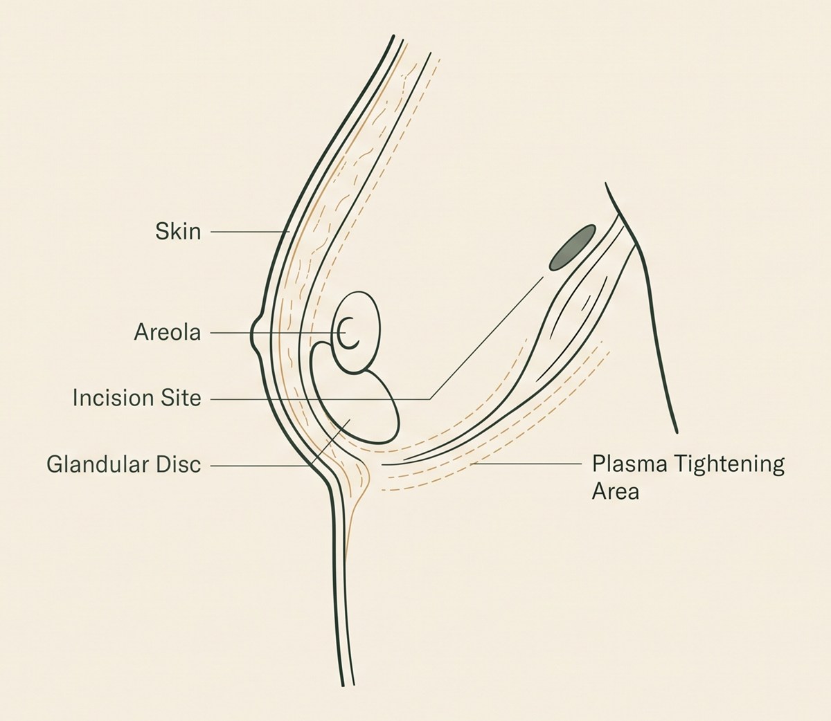 Male chest cross-section diagram: skin, areola, the firm glandular disc beneath the nipple, the periareolar incision site, and the plasma skin-tightening area