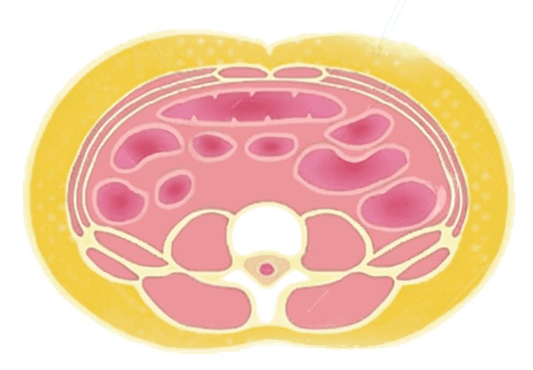 Abdominal cross-section showing subcutaneous fat, the outer layer between skin and muscle that liposuction sculpts