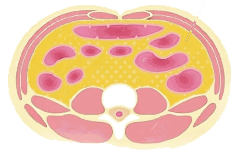Abdominal cross-section showing visceral fat, the deep fat around the organs that liposuction cannot treat