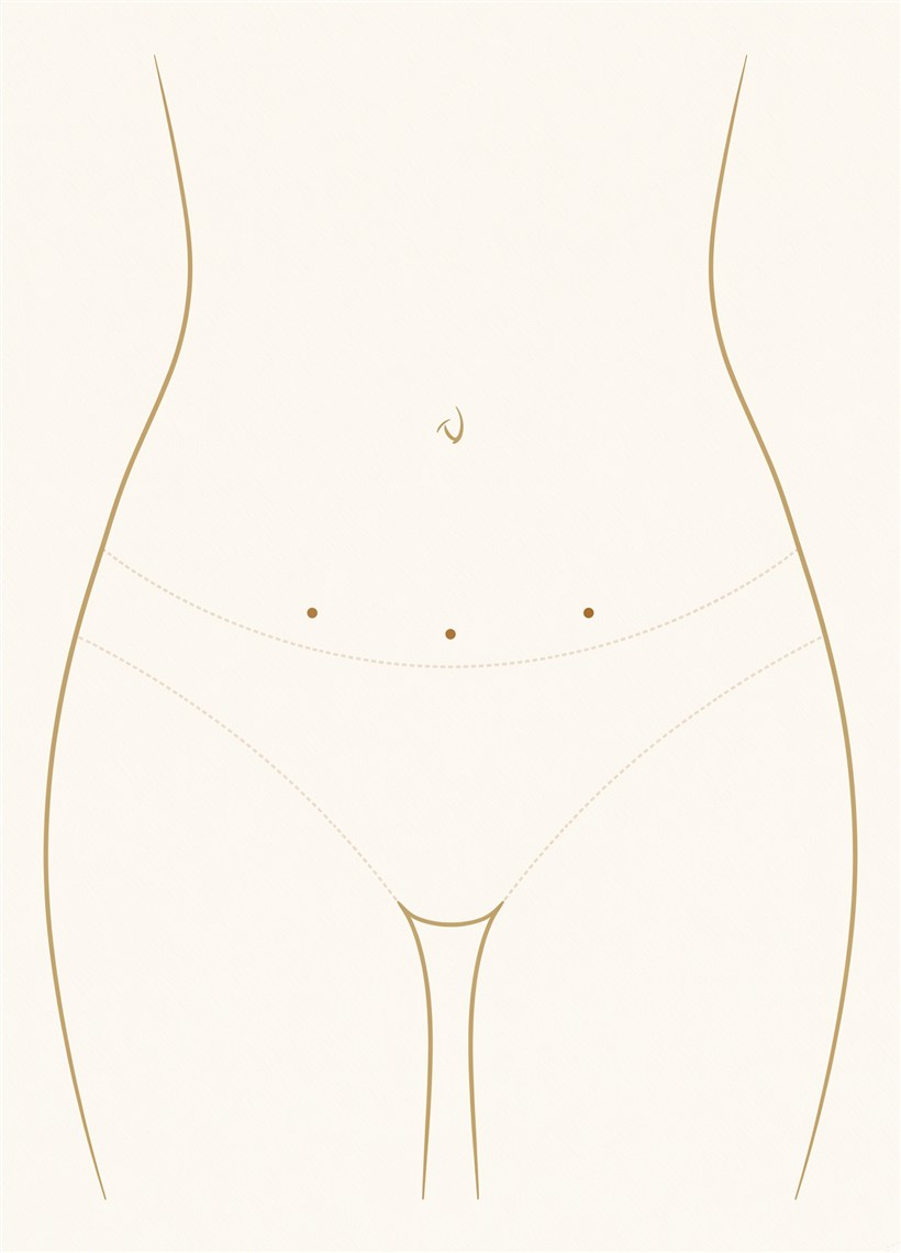 Single torso showing only tiny liposuction incision points low on the abdomen — MILA leaves no scar