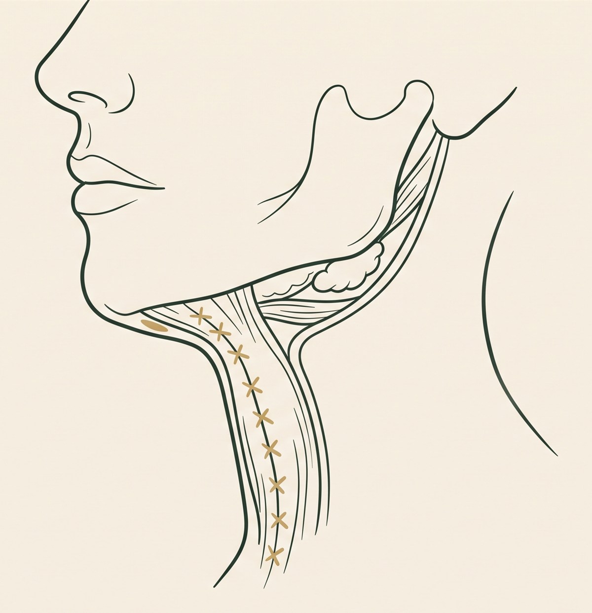 Neck profile diagram: the platysma muscle stitched as a midline corset, subplatysmal fat, the digastric muscle and submandibular gland, and the resulting sharp cervical angle