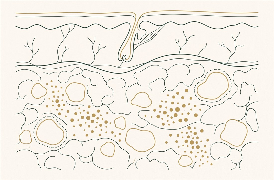 Tissue infiltrated by permanent filler: nodules and granulomas of material dispersed through the subcutaneous layer