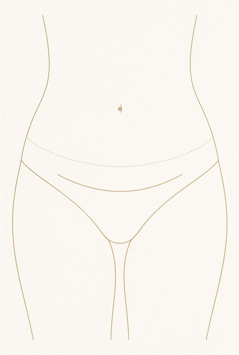 Diagram of the low hip-to-hip tummy tuck incision sitting below the bikini line